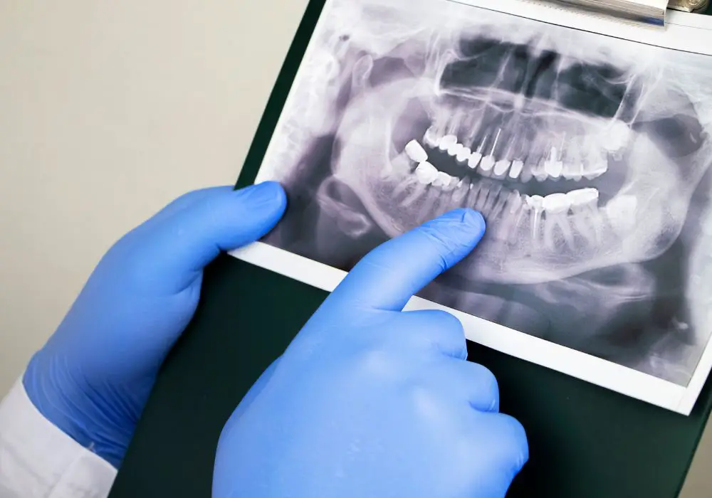 Understanding Bone Loss in Teeth