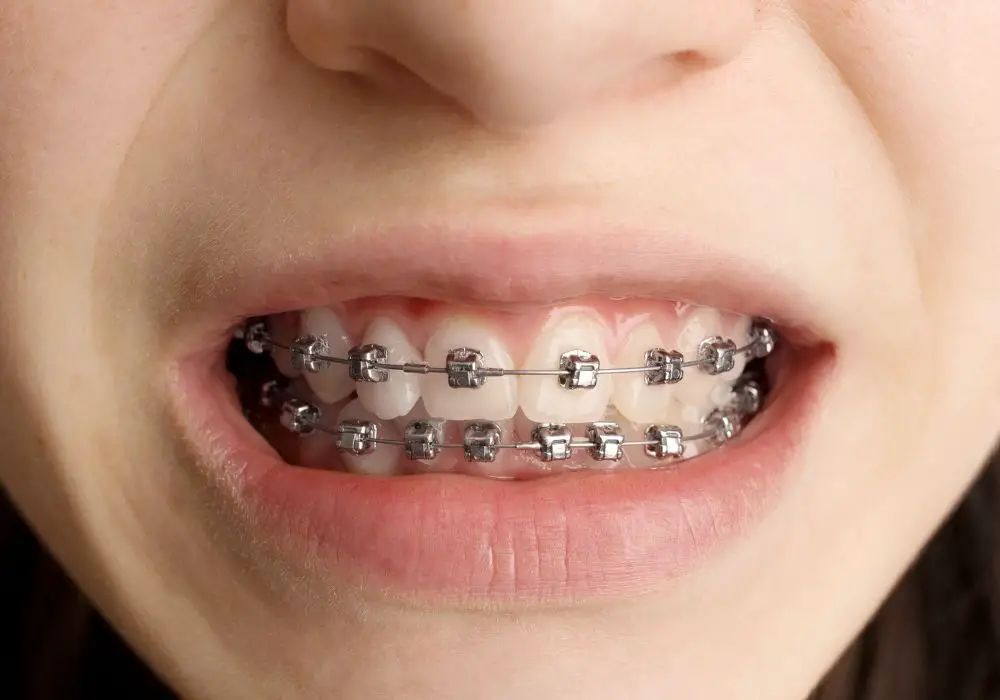 Understanding Braces