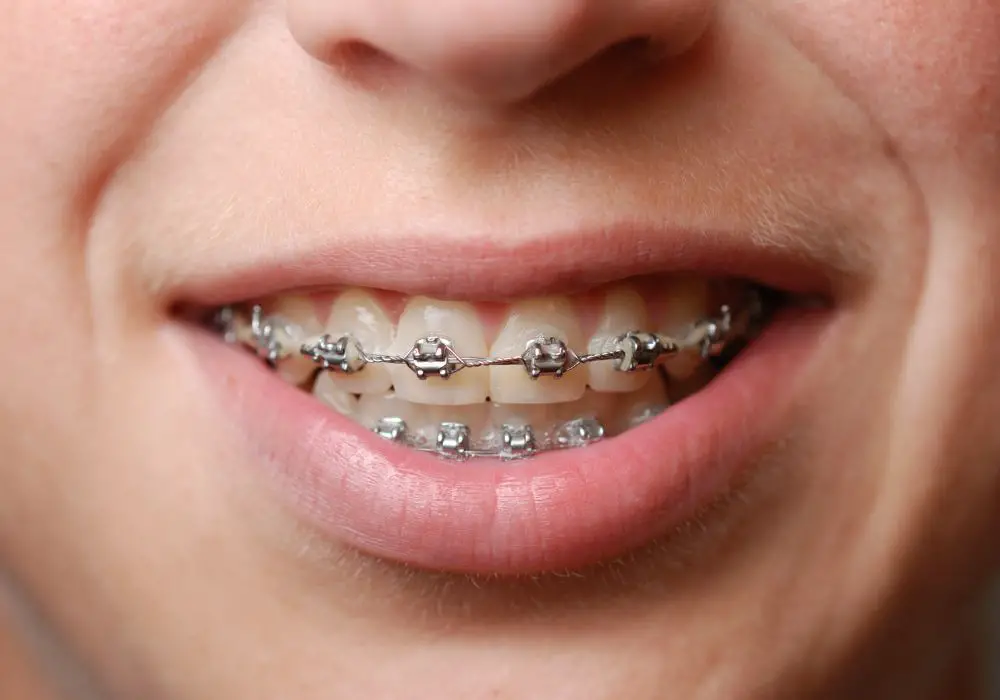 Understanding Dental Braces