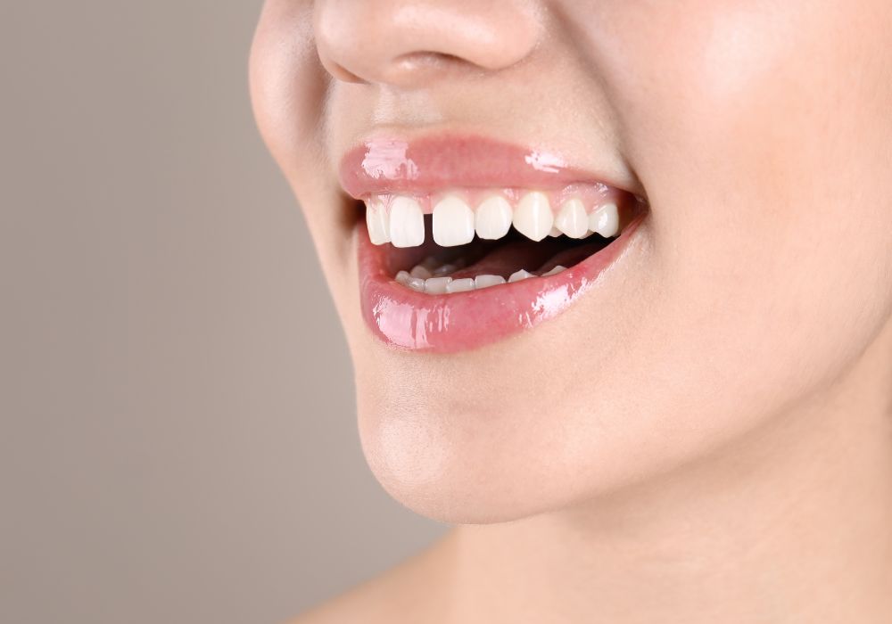 Understanding Dental Gaps