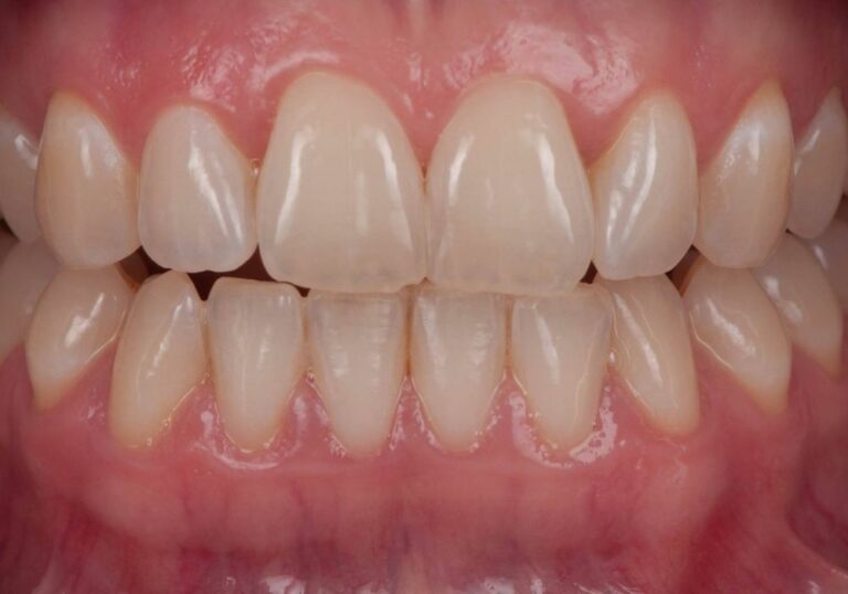What to Do About a Hairline Crack in Your Front Tooth