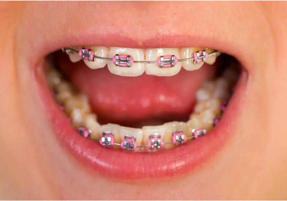 Understanding Post-Braces Tooth Pain