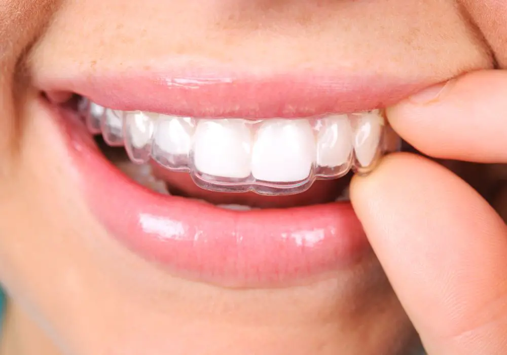 Understanding Teeth Shifting