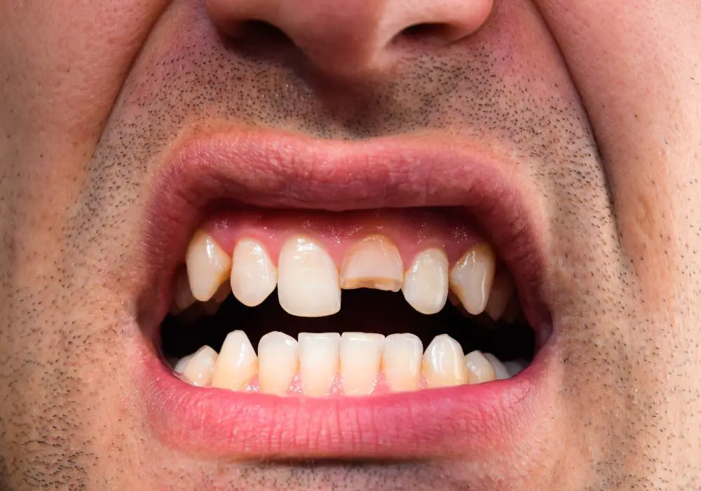 Understanding Tooth Cracks