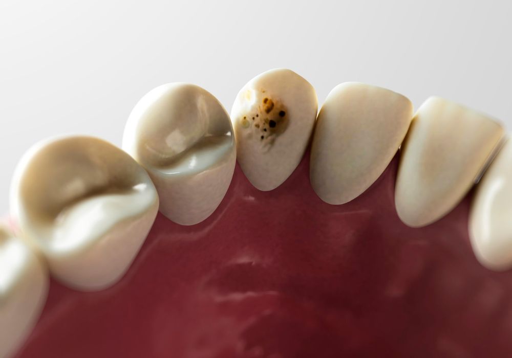 Understanding Tooth Decalcification