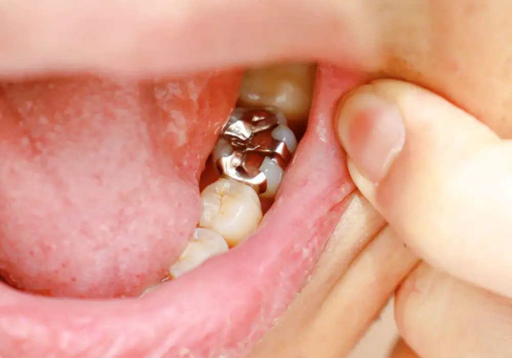 Understanding Tooth Decay and Silver Caps