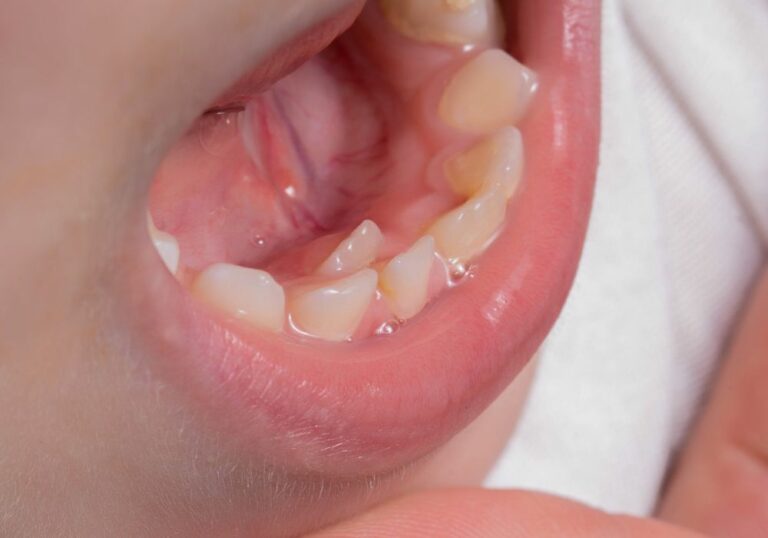 How Many Times Can Human Teeth Grow Back? (Exploring Tooth Regeneration ...