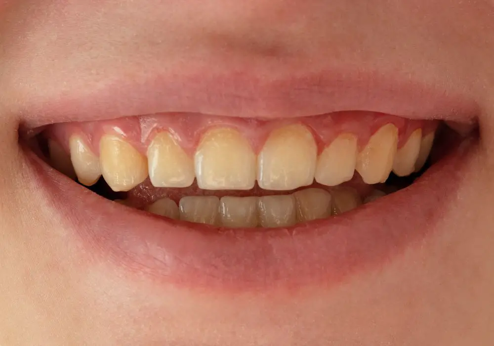 Understanding Tooth Discoloration