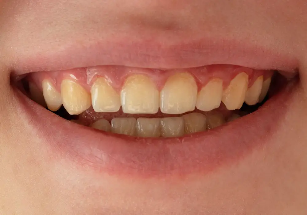 Understanding Tooth Discoloration