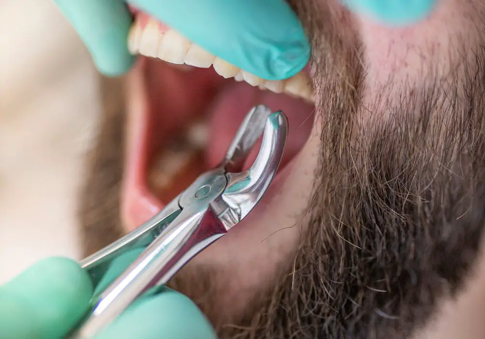 Understanding Tooth Extraction