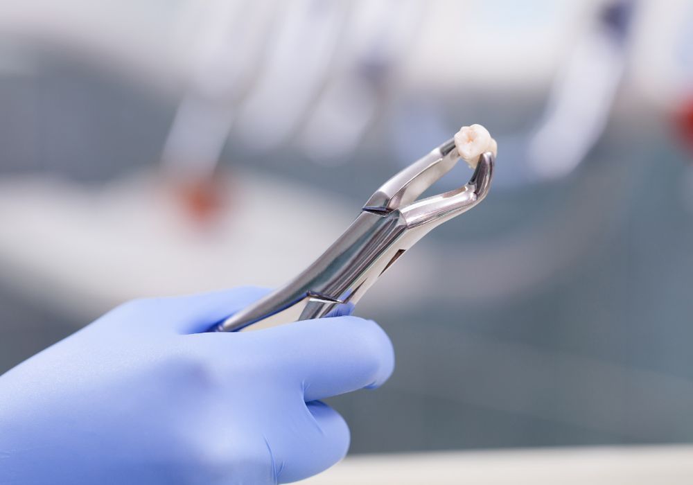 Understanding Tooth Extraction with Stitches