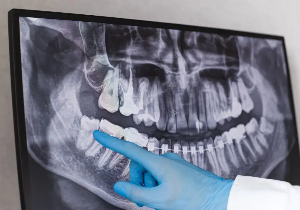 Understanding Wisdom Teeth