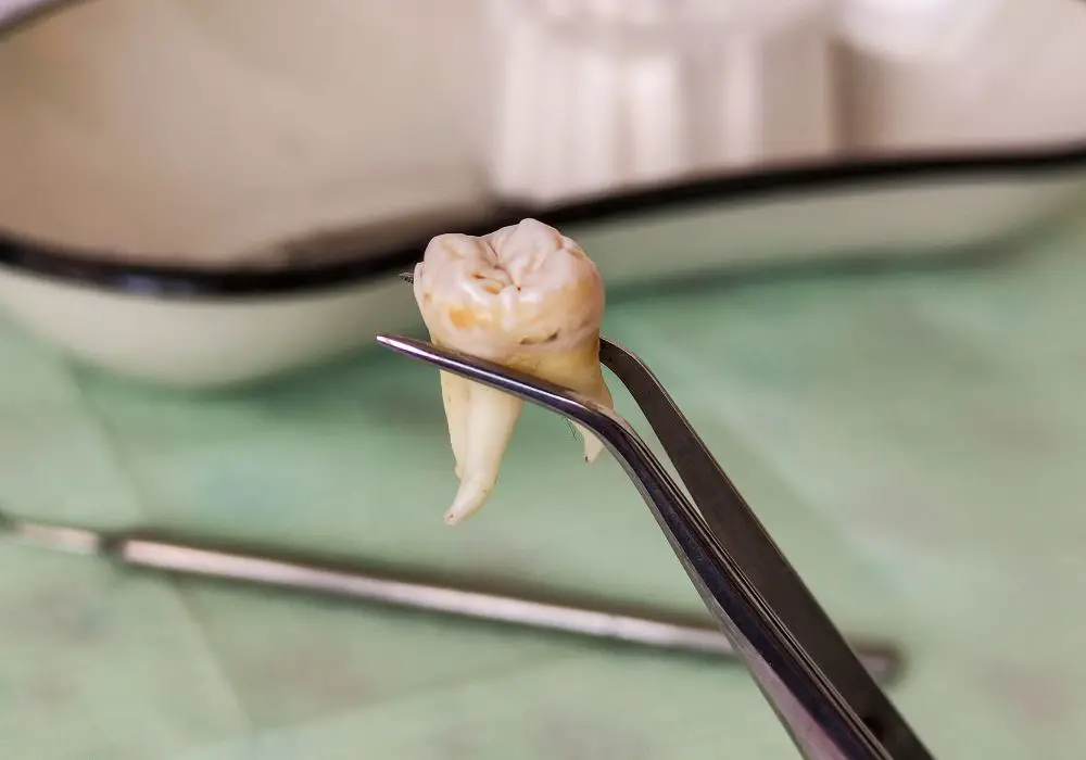 Understanding Wisdom Teeth Removal