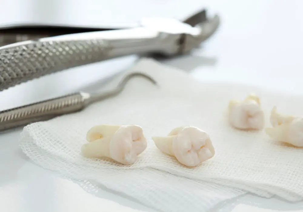 Understanding Wisdom Teeth Removal