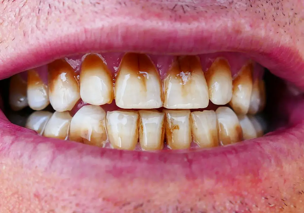Understanding Yellow Teeth from Smoking
