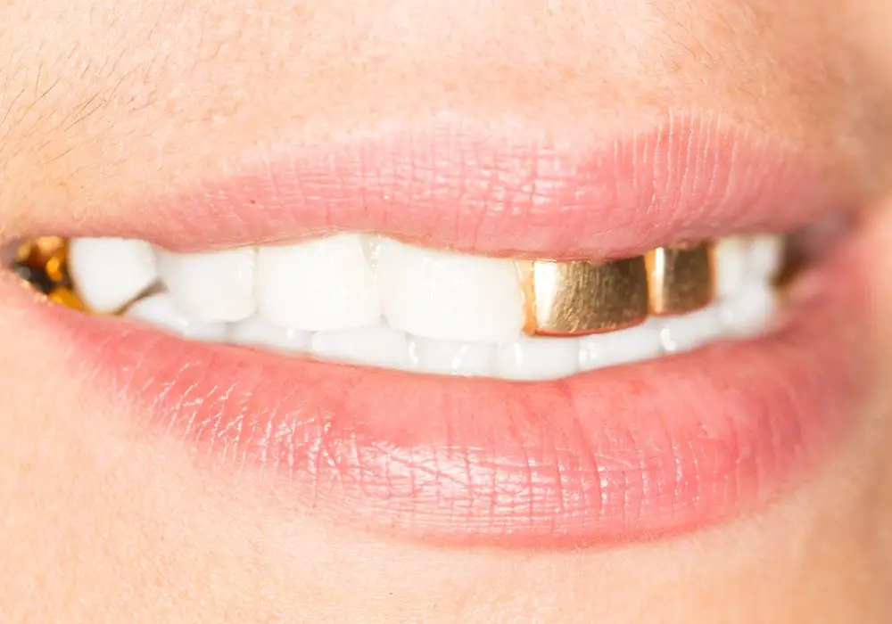 Value of Gold Teeth