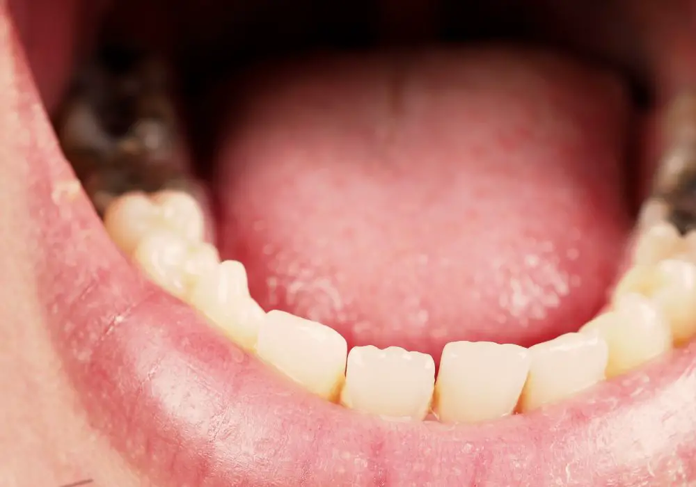 What Causes Black Decay on Teeth