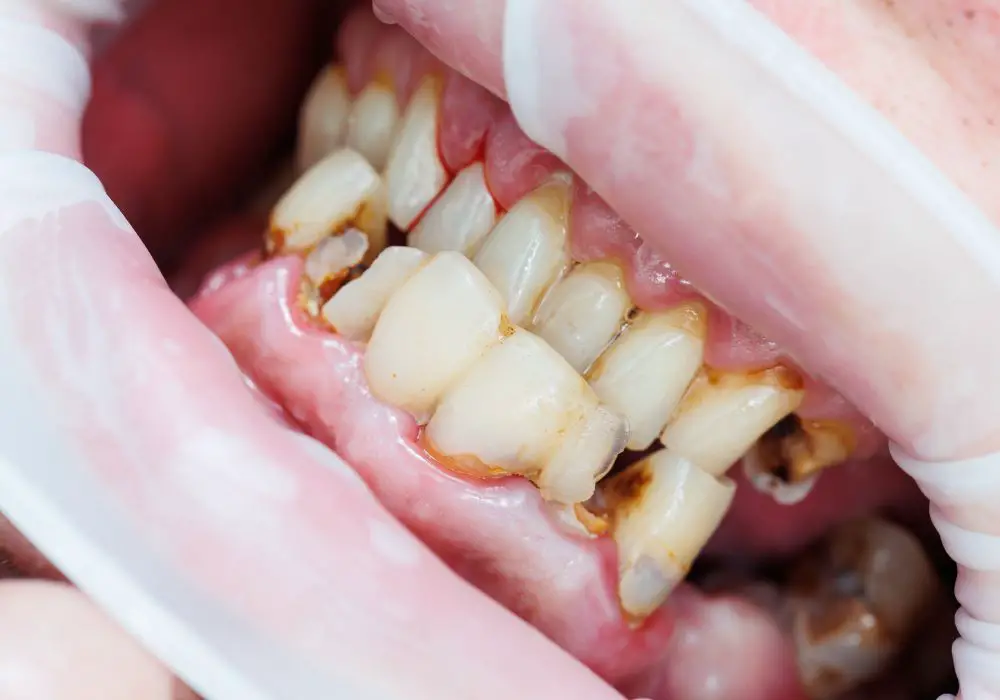 What Causes Front Teeth to Rot?