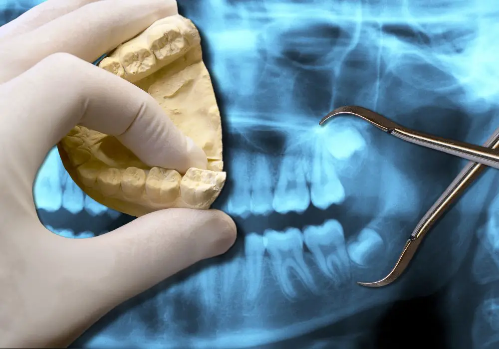 What Causes Impacted Wisdom Teeth