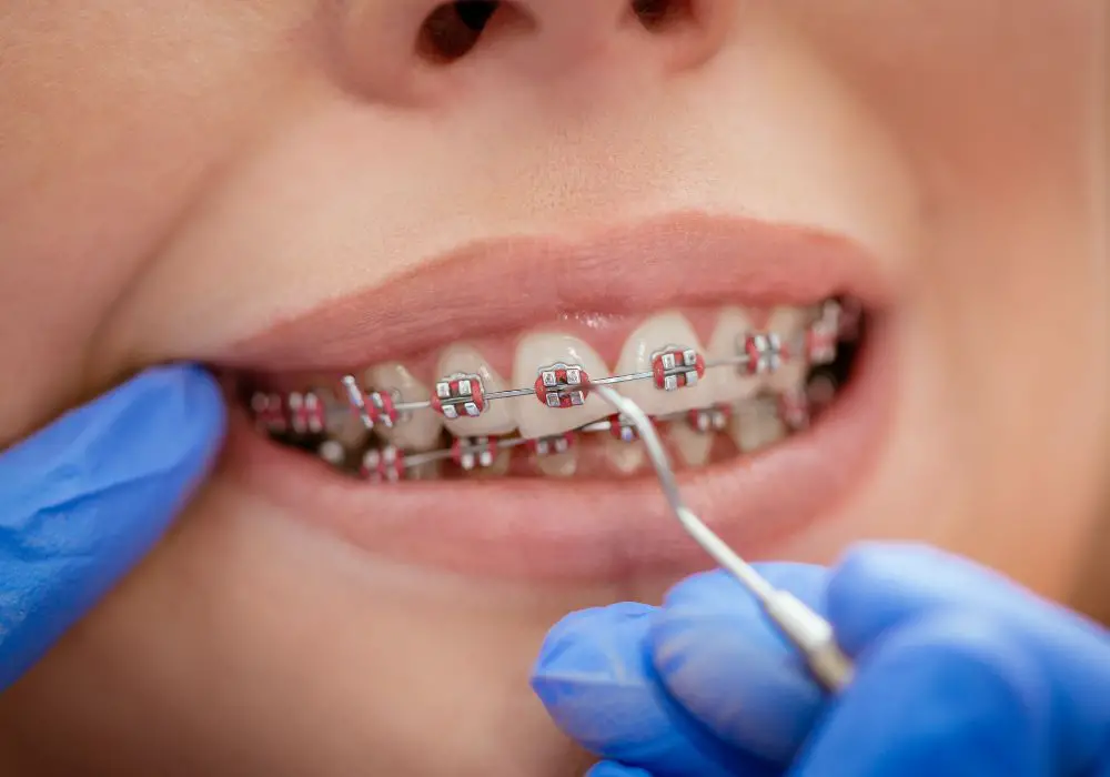 What Causes Teeth Staining After Braces?