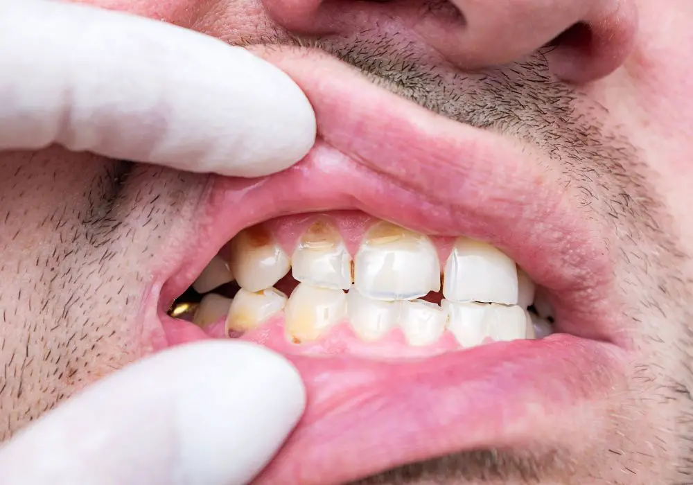 What Exactly is a Chipped Tooth?