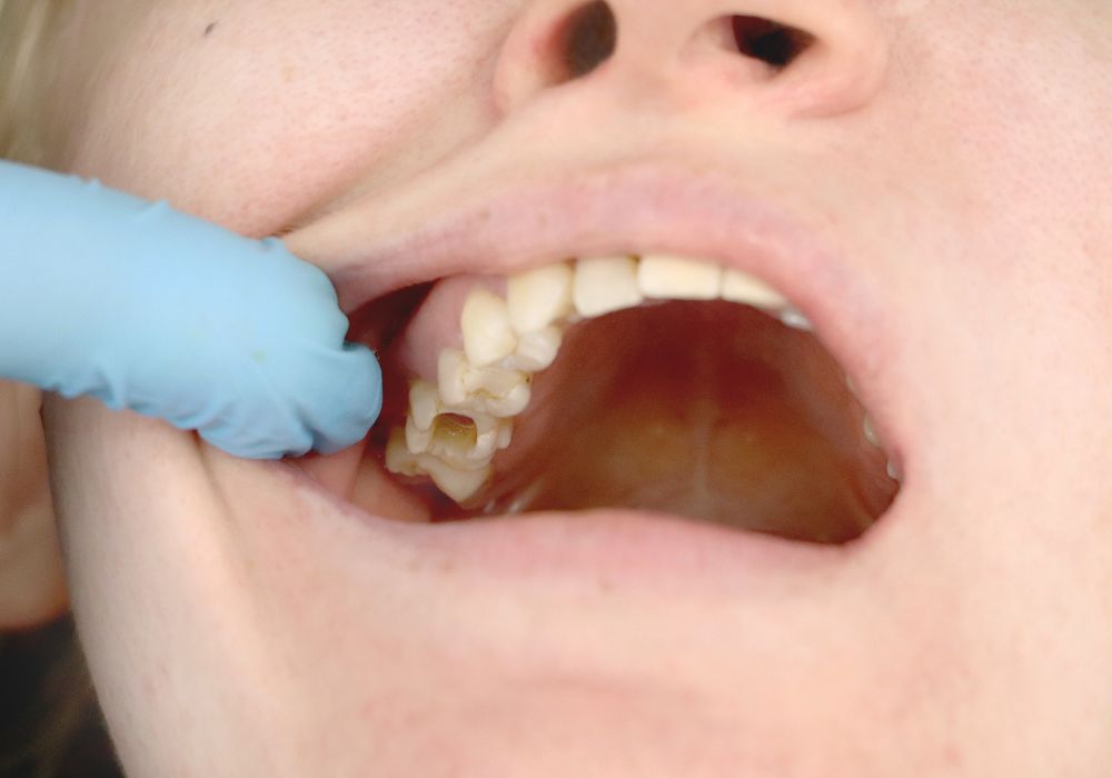 What Factors Cause Large Cavities to Develop?