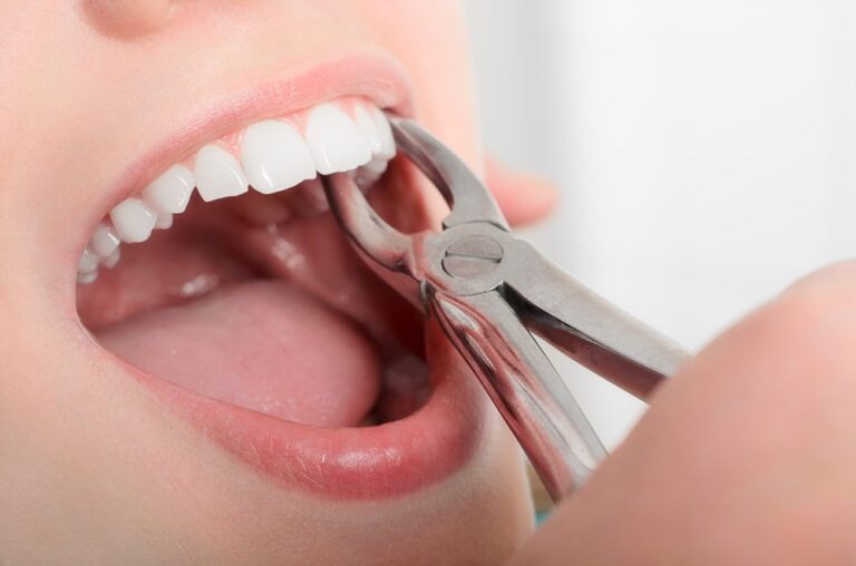 What Foods Can You Eat 24 Hours After Tooth Extraction?