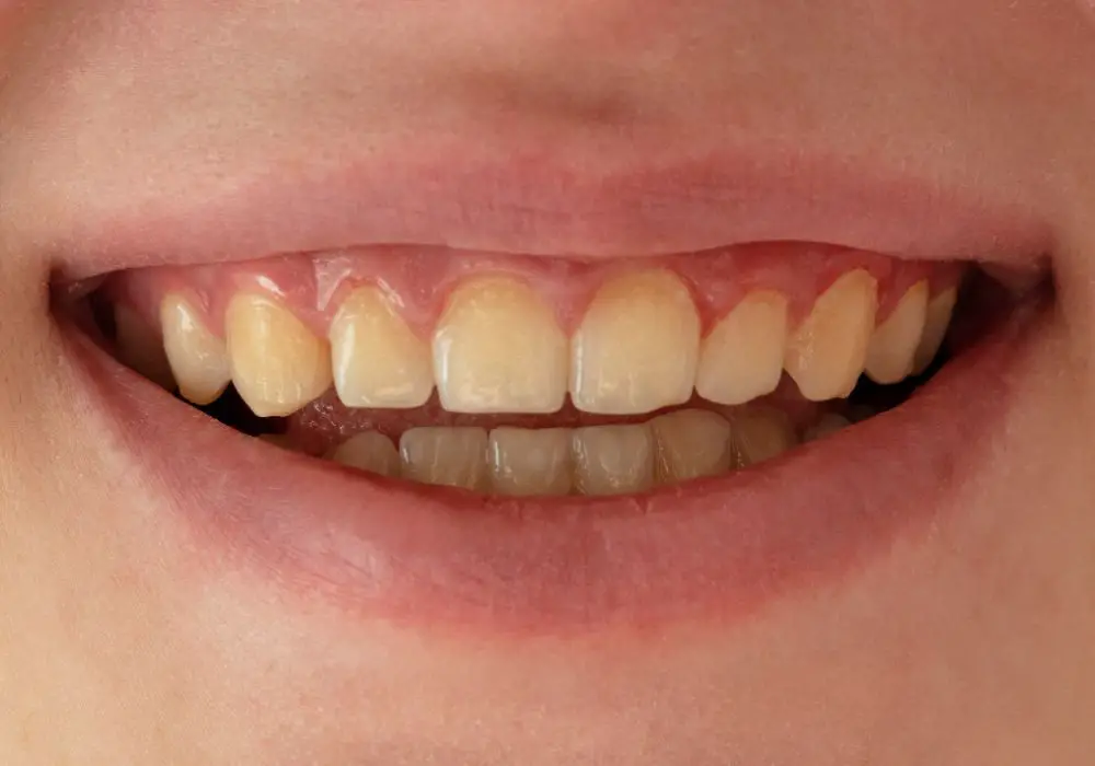 What Makes Teeth Turn Yellow?