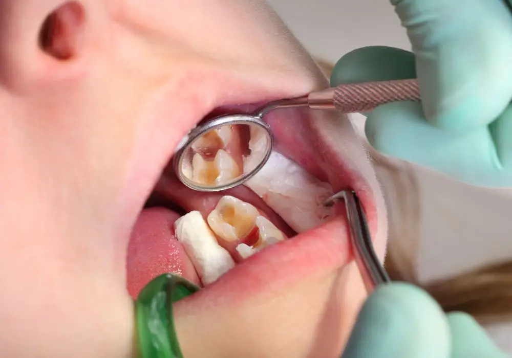 What Processes Cause Cavities to Develop?