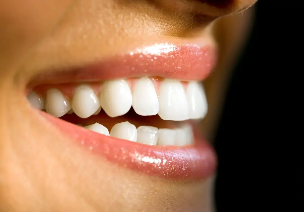 What are Bonded Teeth