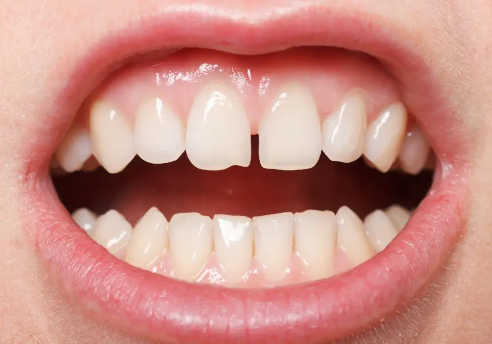 What are canine teeth?