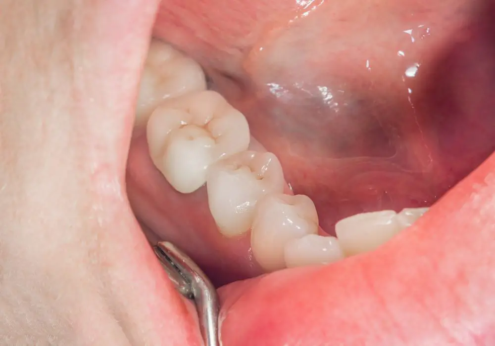 What are dental crowns and why are they used
