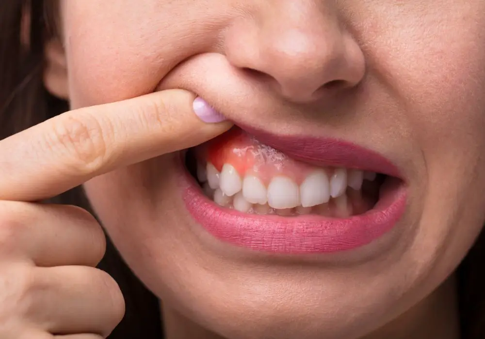 What are possible complications from gum grafting treatment?