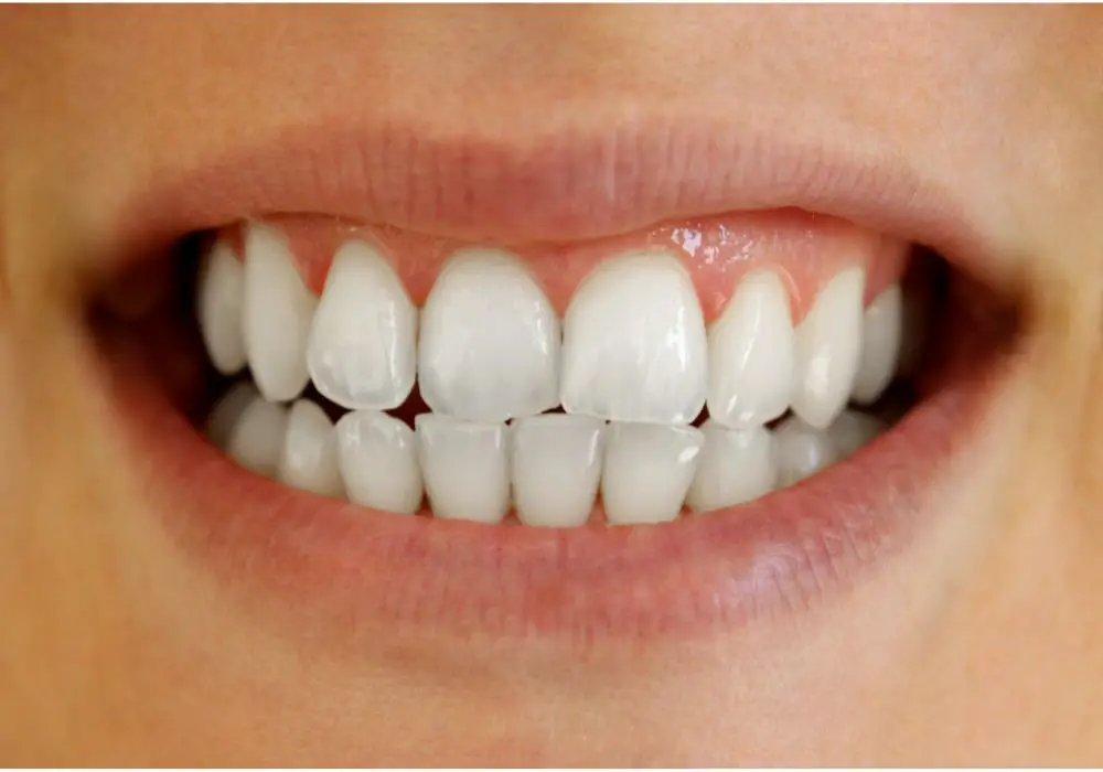 What are the treatment options for cavities on front teeth?