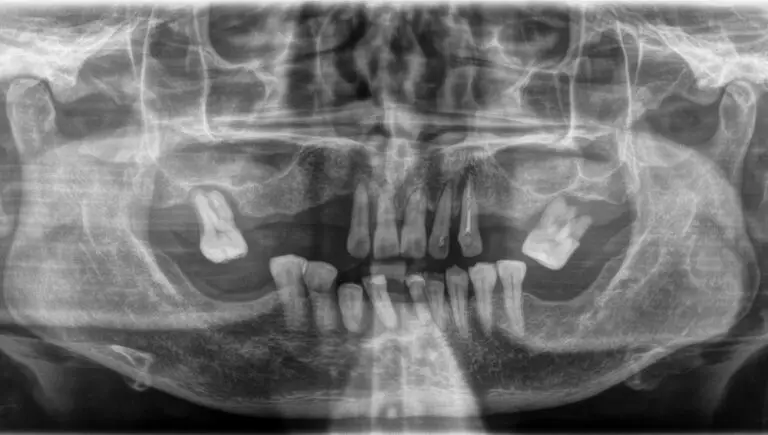 What Can Be Done For Tooth Bone Loss? (Nonsurgical & Surgical Treatments)