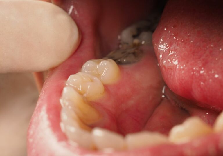 What can untreated tooth decay lead to? (Everything You Need To Know)