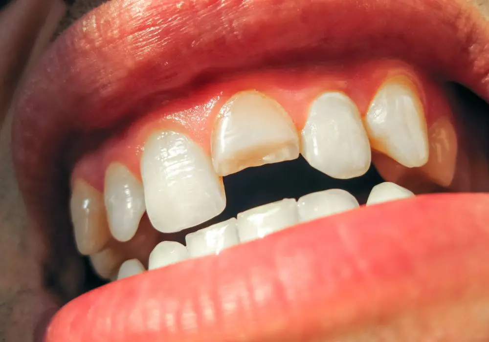 What causes chips in teeth?