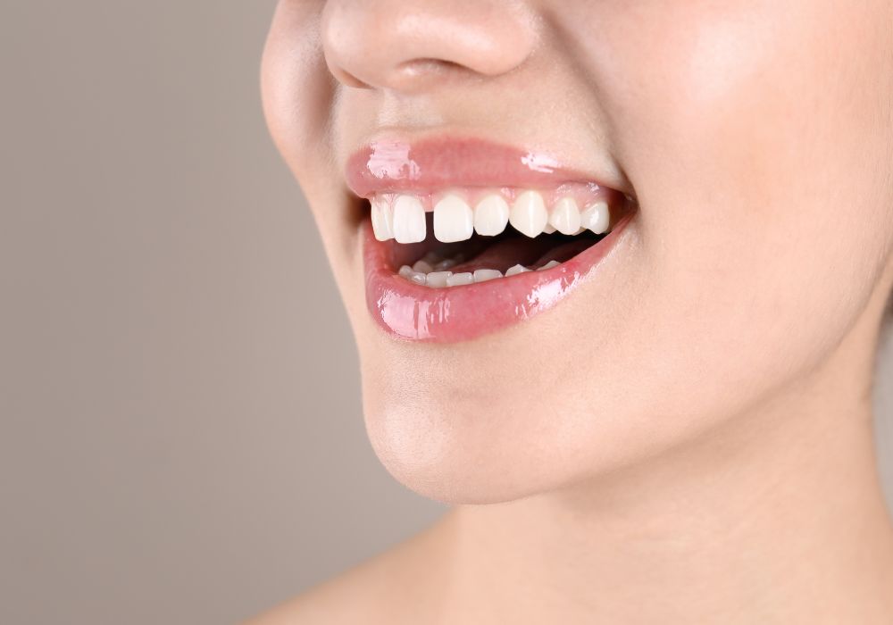 What causes gaps in teeth and why are they common?