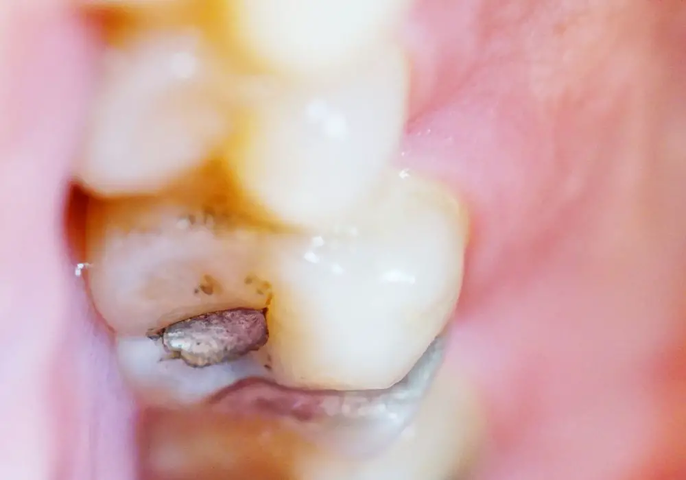 What causes holes in teeth?
