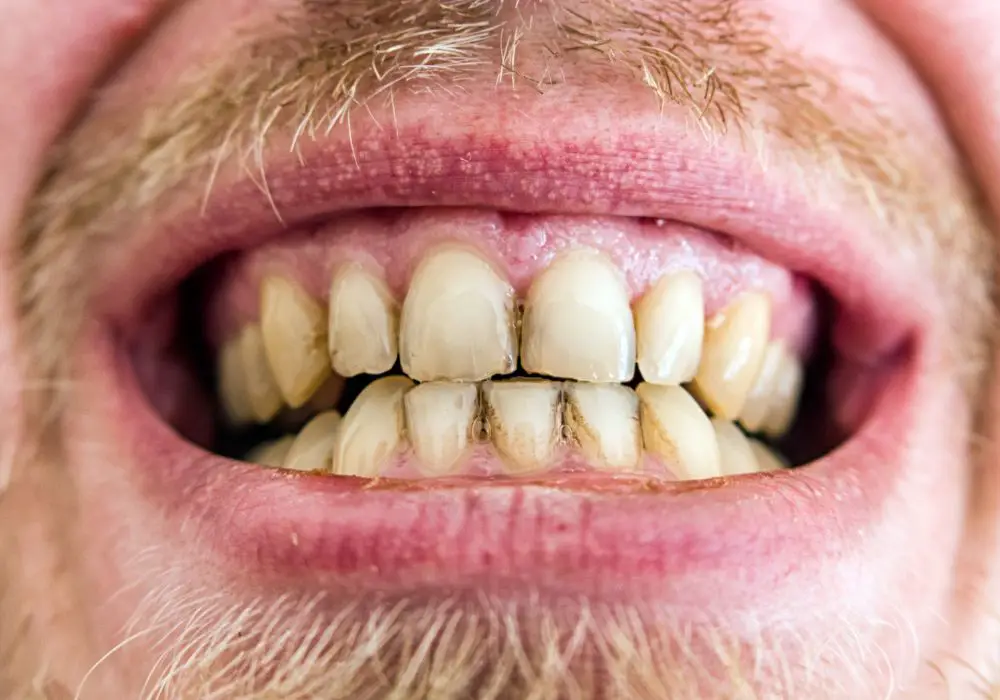 What causes such severe yellowing of teeth