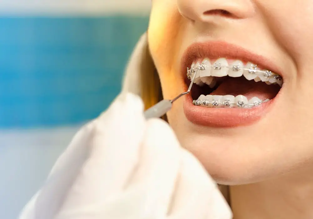 What causes teeth to become slanted after braces are removed