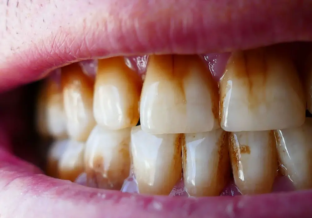 What causes teeth to become stained?
