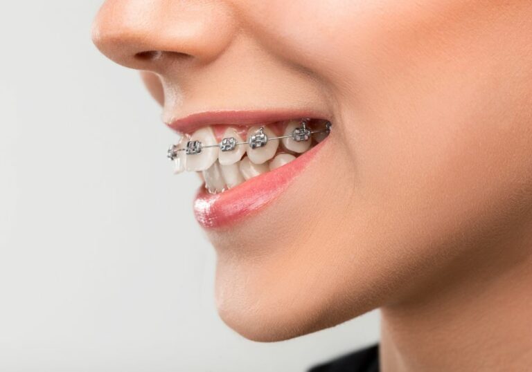 Why Is My Teeth Popping With Braces? (Causes & What To Do)