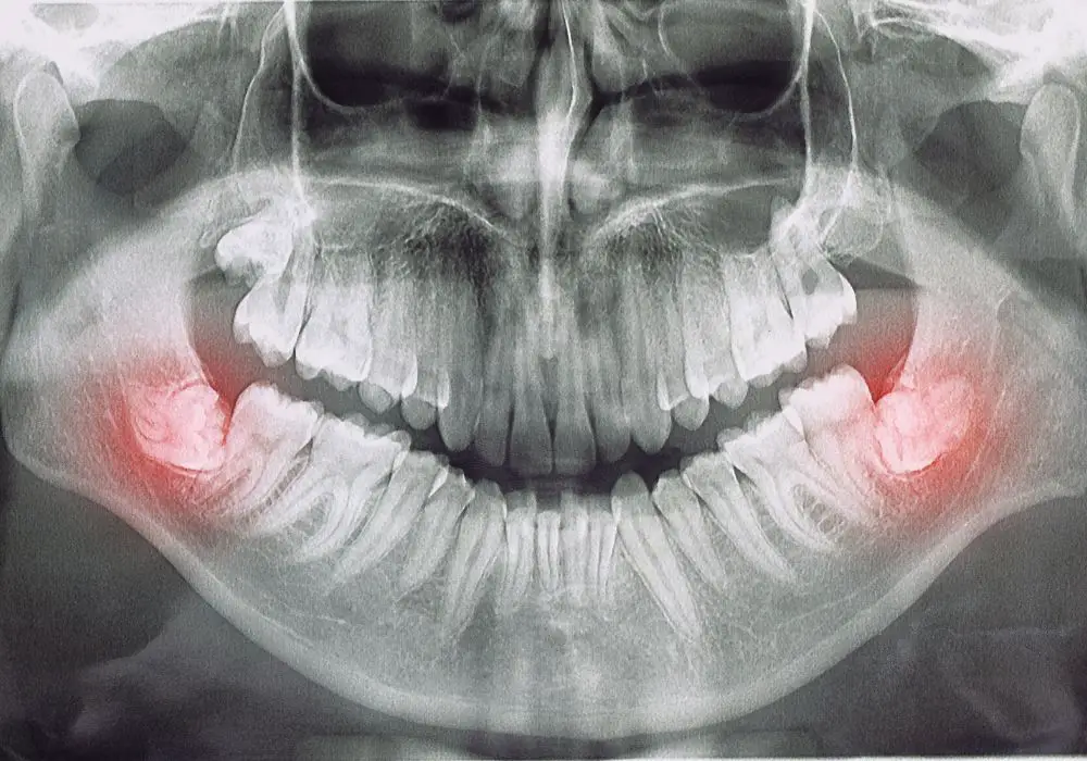 What causes wisdom teeth to affect alignment?