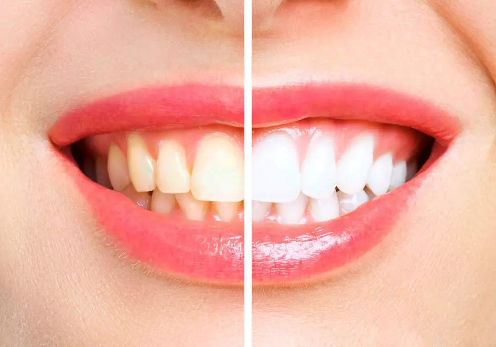 What to Do In the Weeks Before Your Date for Whiter Teeth