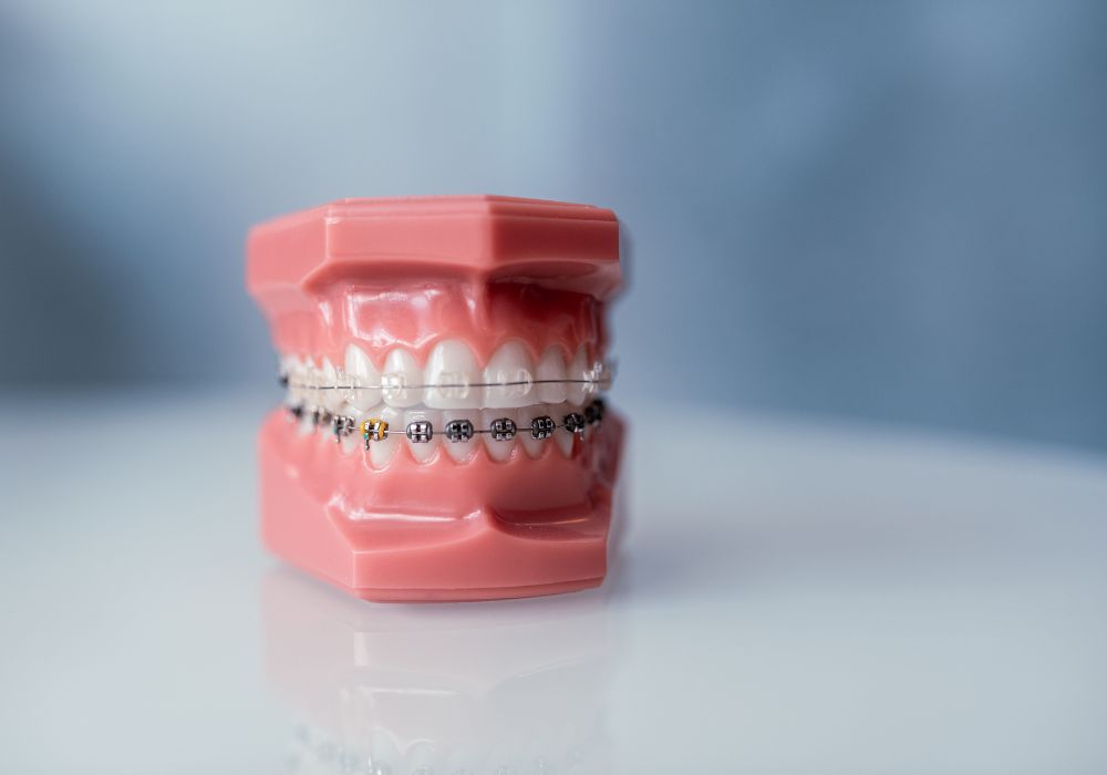 What to expect from braces versus aligners