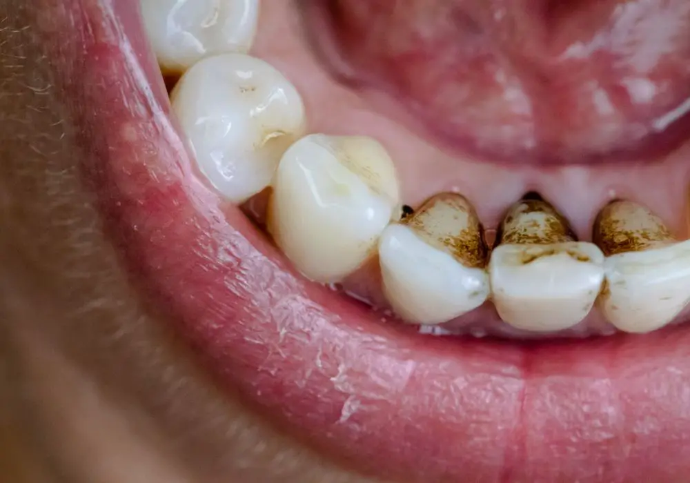 When Should Someone Seek Dental Care for Blackened Teeth?