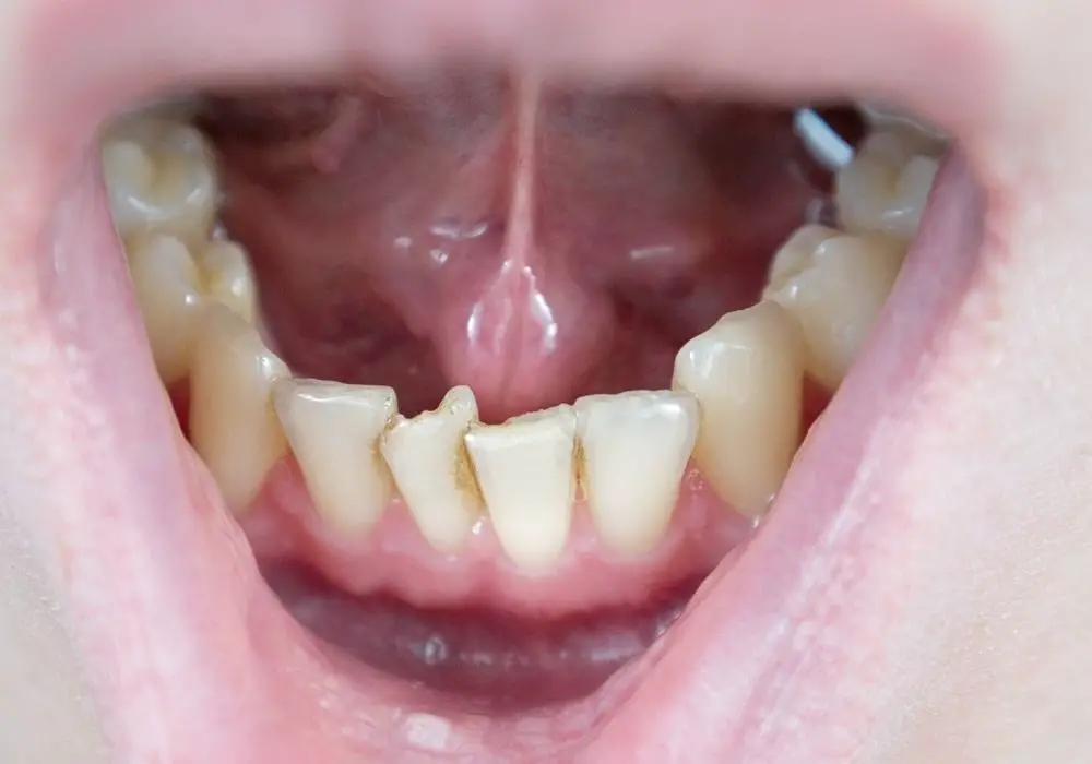 When is Orthodontic Treatment Recommended?