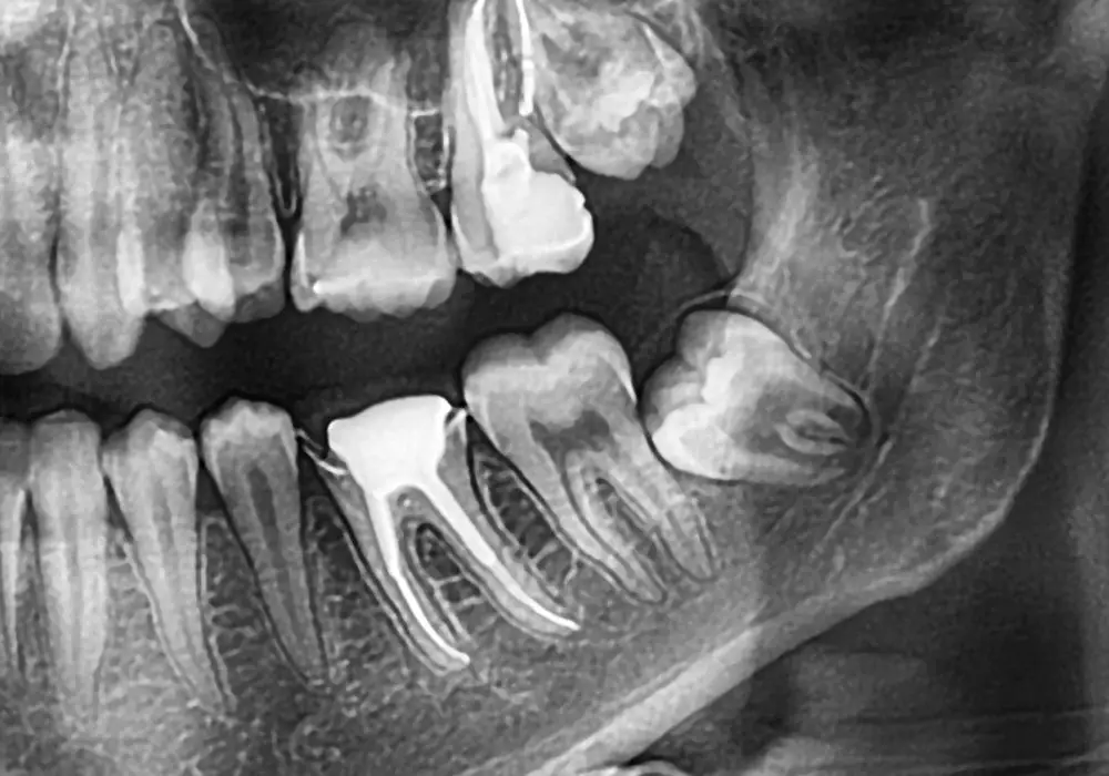When should impacted wisdom teeth be removed?