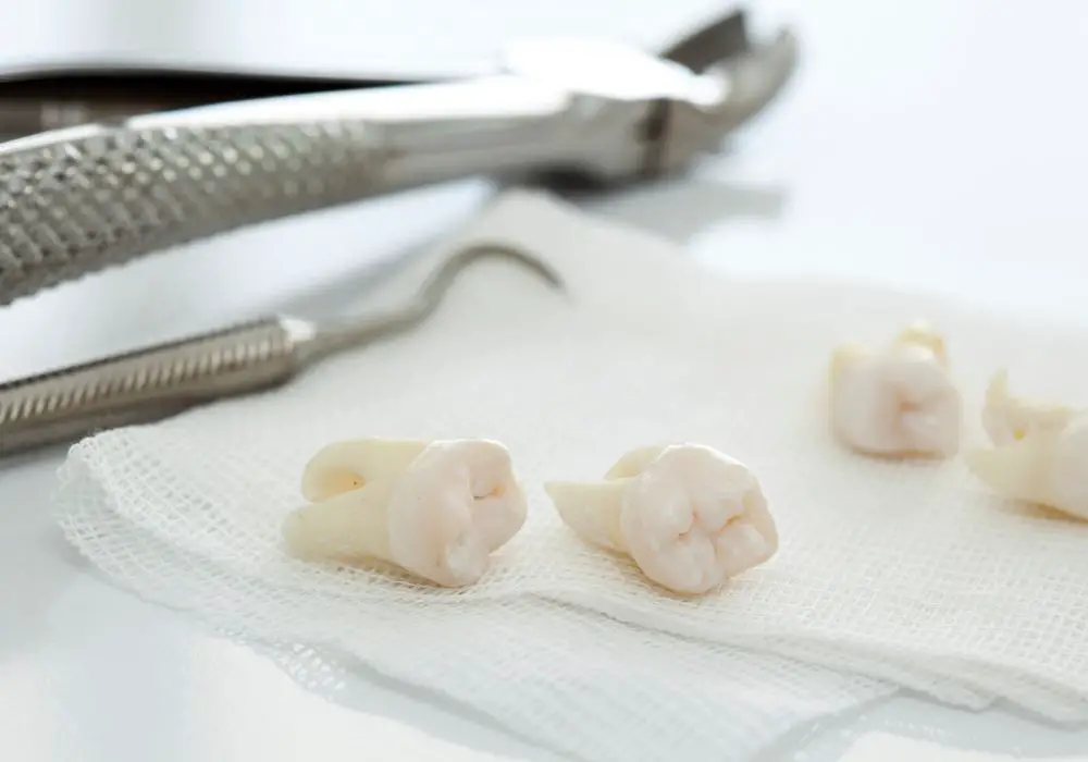 When to Call Your Dentist After Extractions?